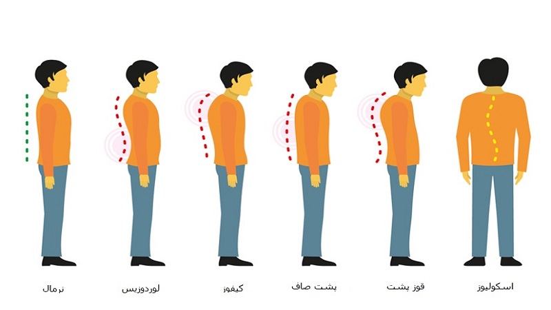 کیفوز - کایفوز - قوز پشتی (گوژپشتی) 
