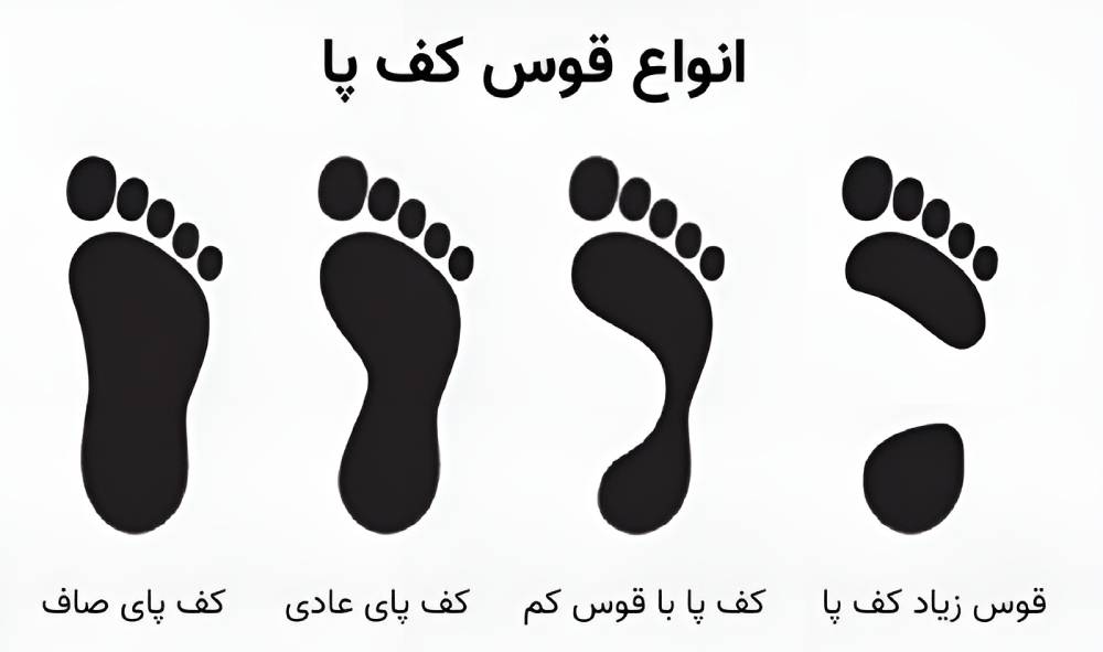 انواع قوس پا