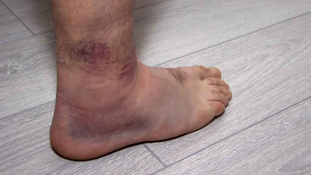 shutterstock 1655819734 ankle sprain 1024x683 1 - پیچ خوردگی مچ پا