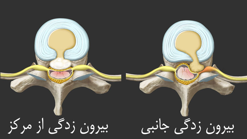 بیرون زدگی دیسک
