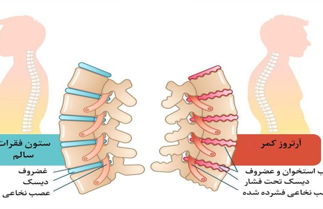 آرتروز کمر