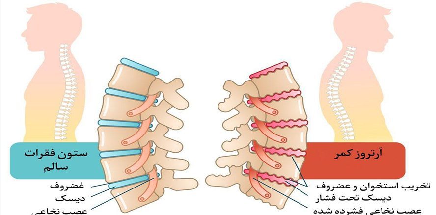 آرتروز کمر