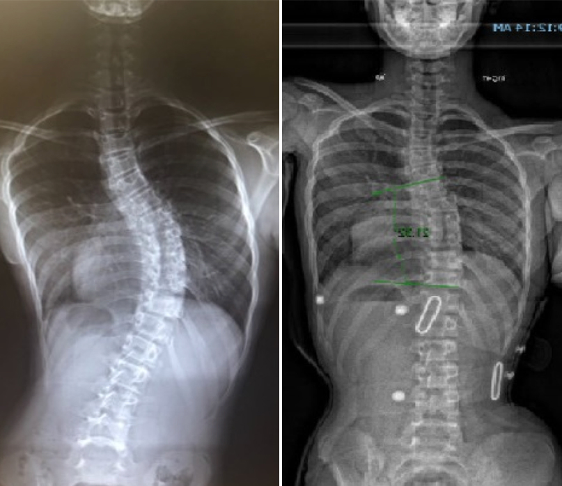 over corrective brace loc scoliosis example 2 - اسکولیوز