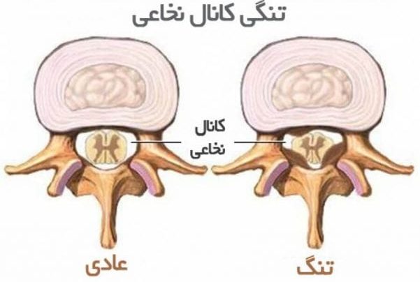 تنگی کانال کمر