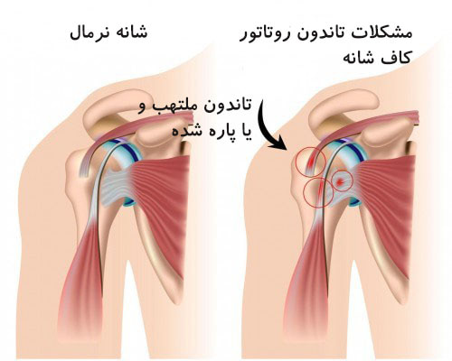 شانه min 1 - تاندونیت شانه (بیماری قوس دردناک شانه)