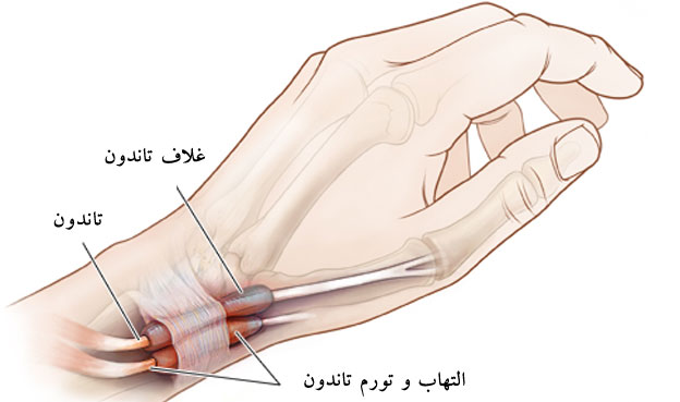 .jpg - سندرم دکورون (درد شست دست)